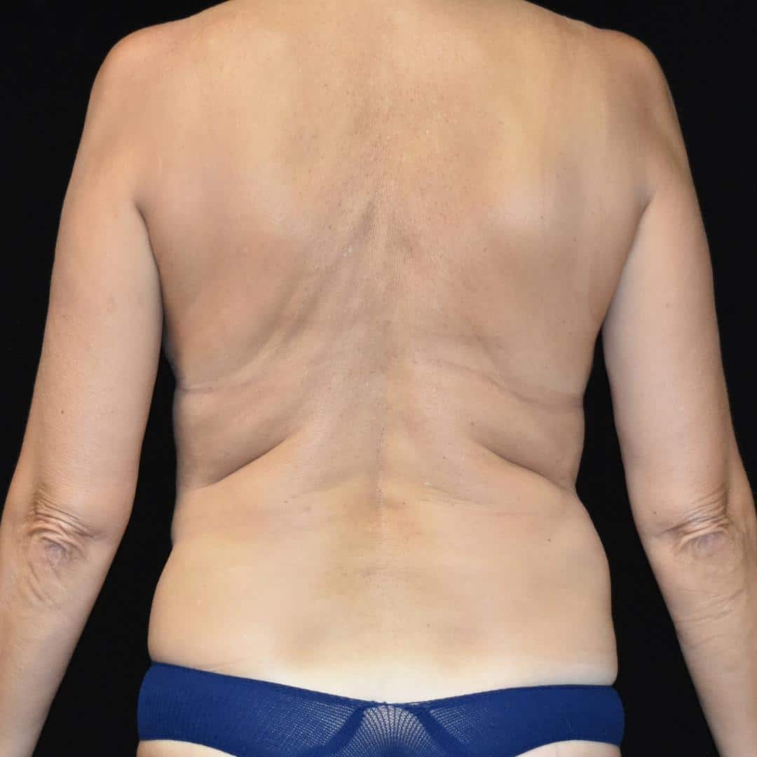 BodyTite & Liposuction Patient Photo - Case 7744 - before view-0