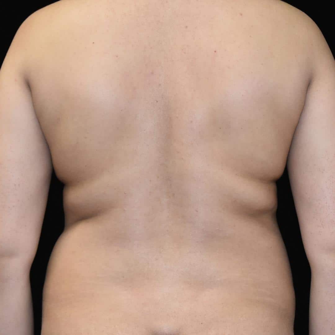 BodyTite & Liposuction Patient Photo - Case 7747 - before view-