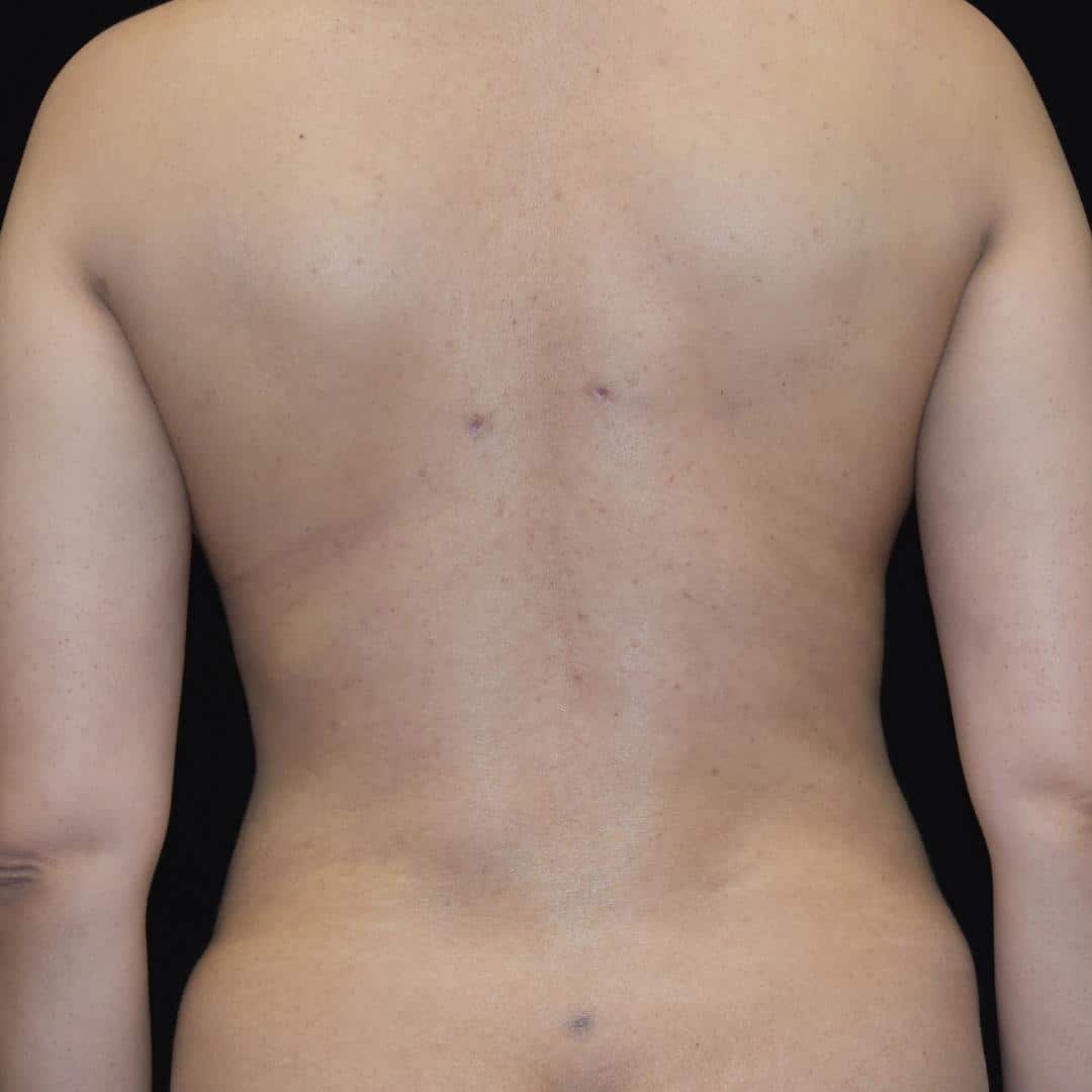 BodyTite & Liposuction Patient Photo - Case 7747 - after view