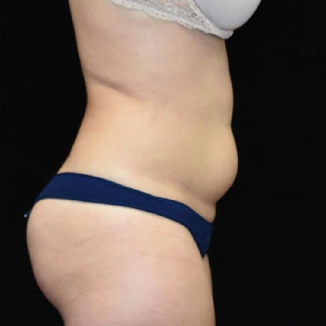 BodyTite & Liposuction Patient Photo - Case 7751 - before view-1