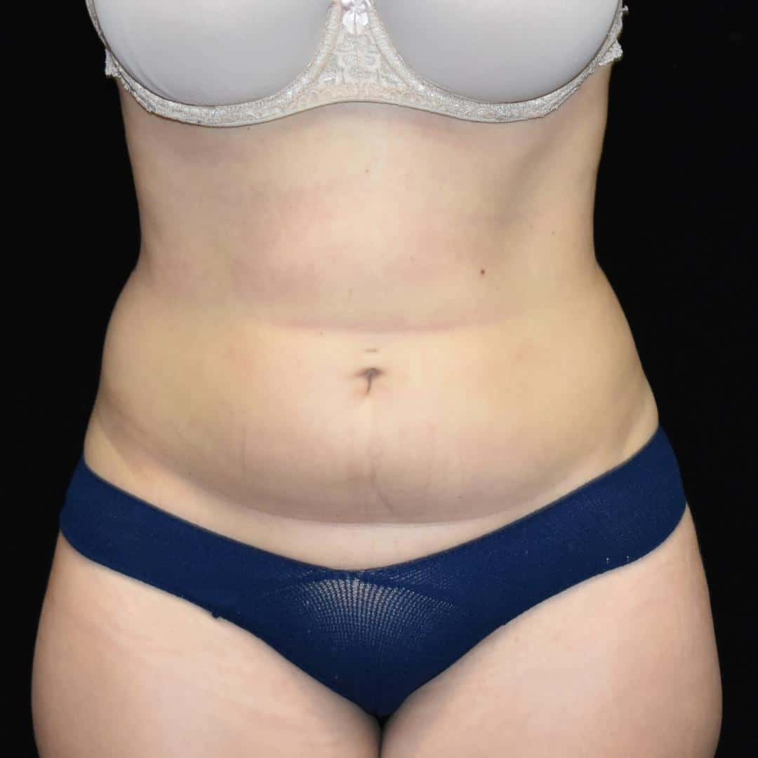BodyTite & Liposuction Patient Photo - Case 7751 - before view-0