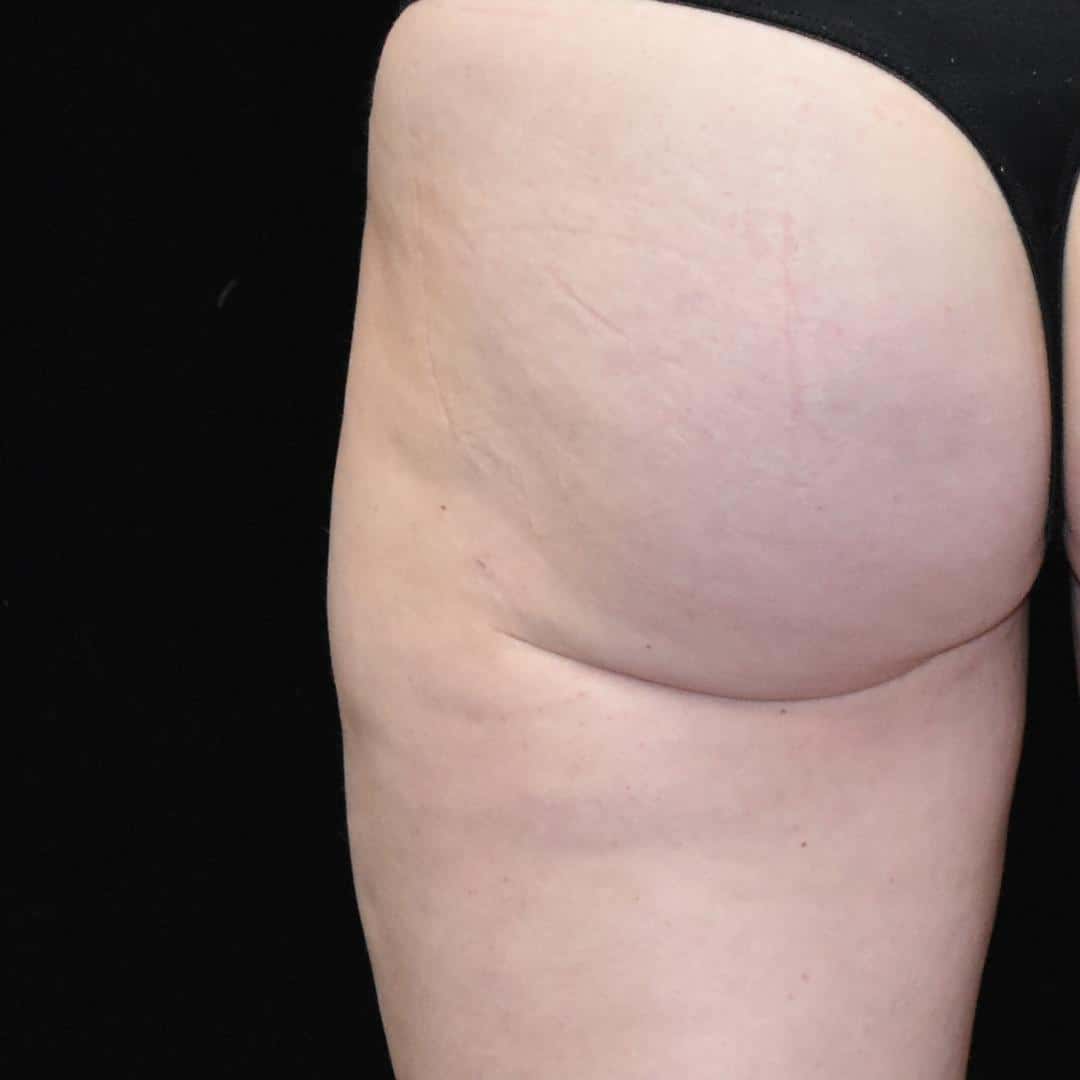 BodyTite & Liposuction Patient Photo - Case 7756 - after view-1