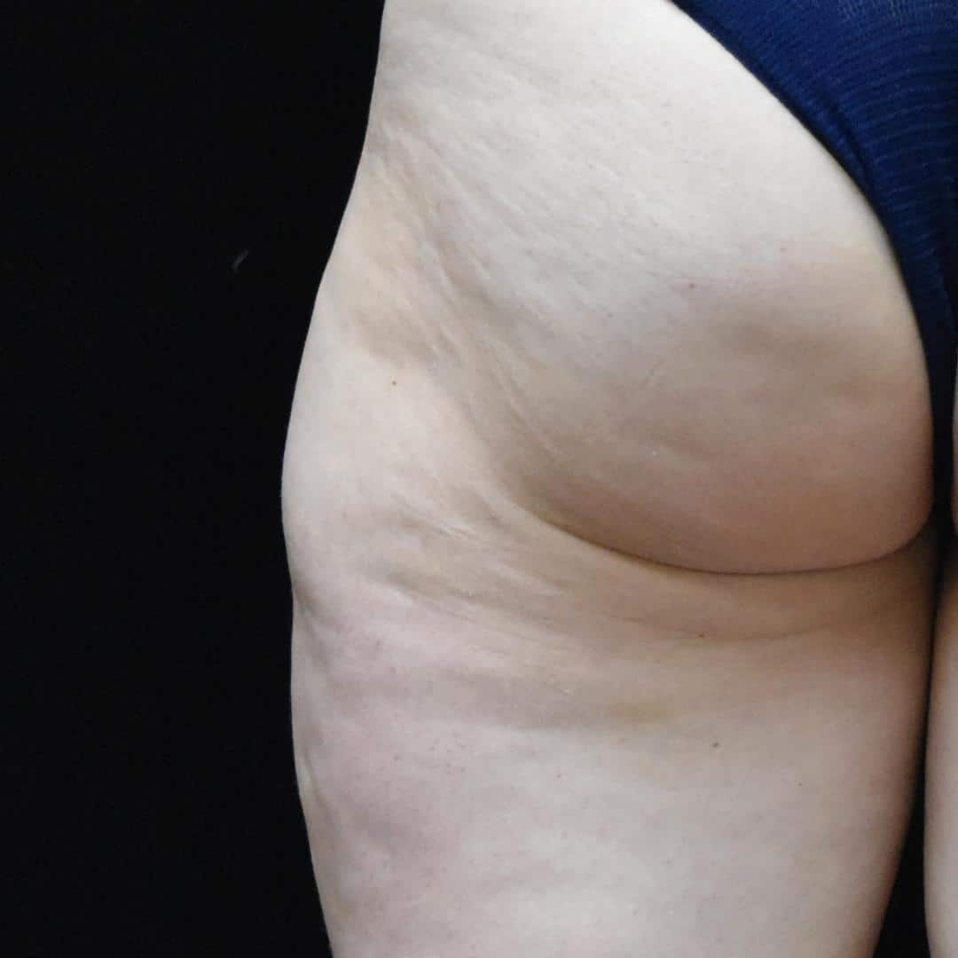 BodyTite & Liposuction Patient Photo - Case 7756 - before view-1