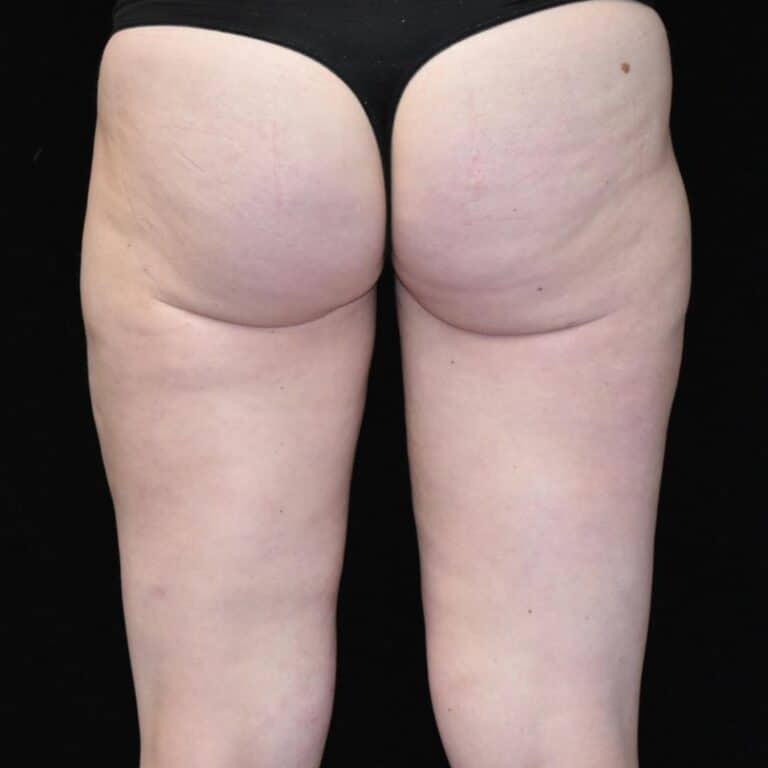 BodyTite & Liposuction - Case 7756 - After