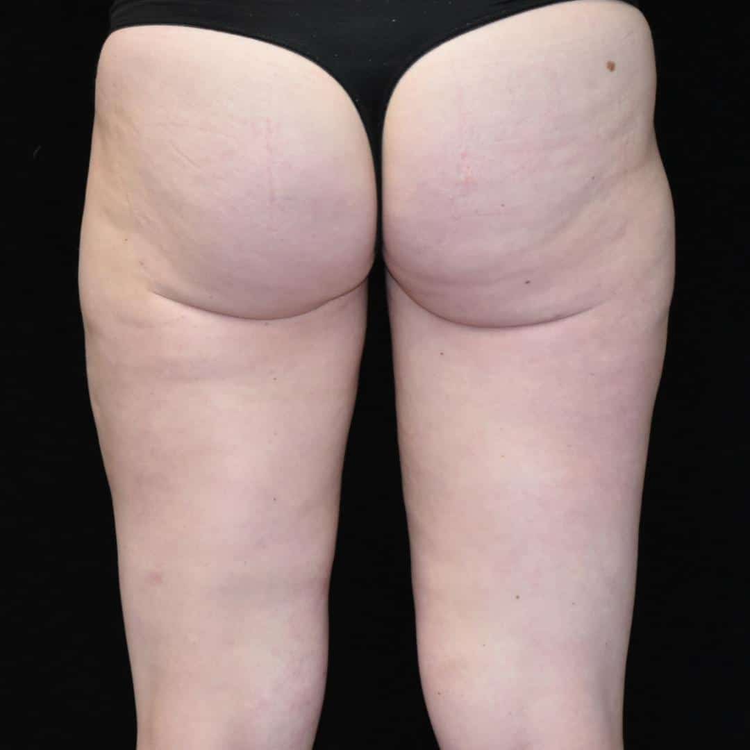BodyTite & Liposuction Patient Photo - Case 7756 - after view