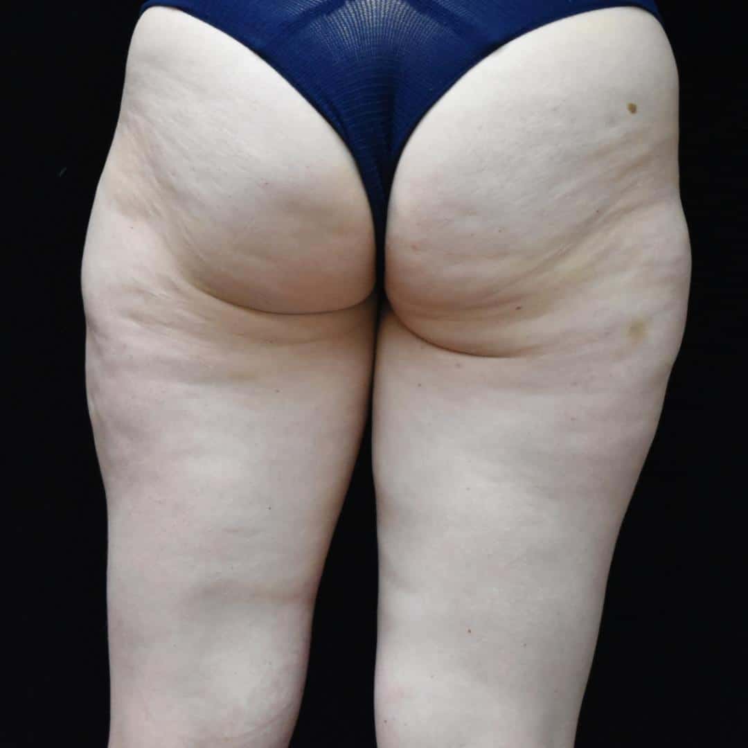 BodyTite & Liposuction Patient Photo - Case 7756 - before view-
