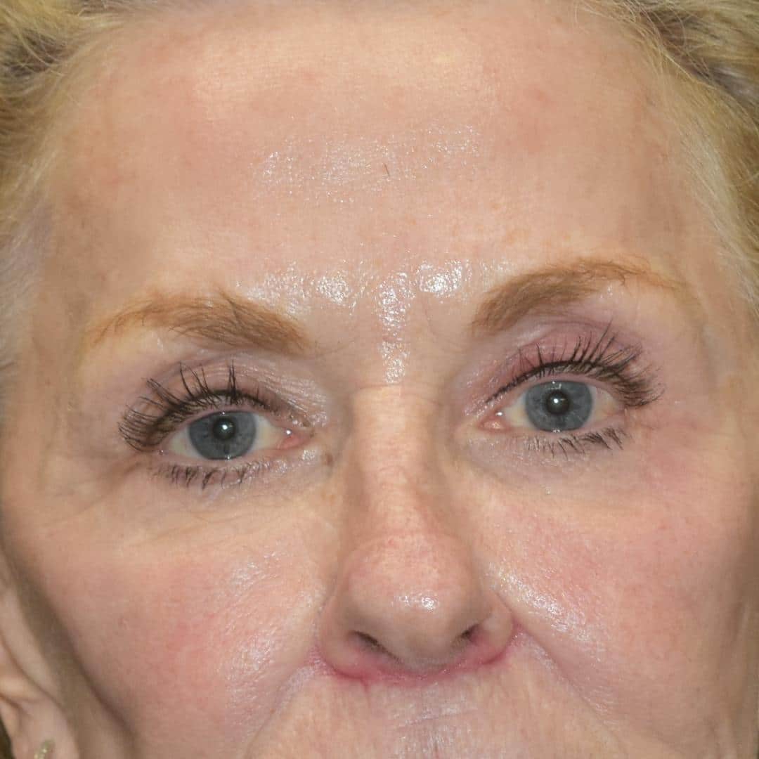 Botox & Dysport Patient Photo - Case 7774 - after view-0