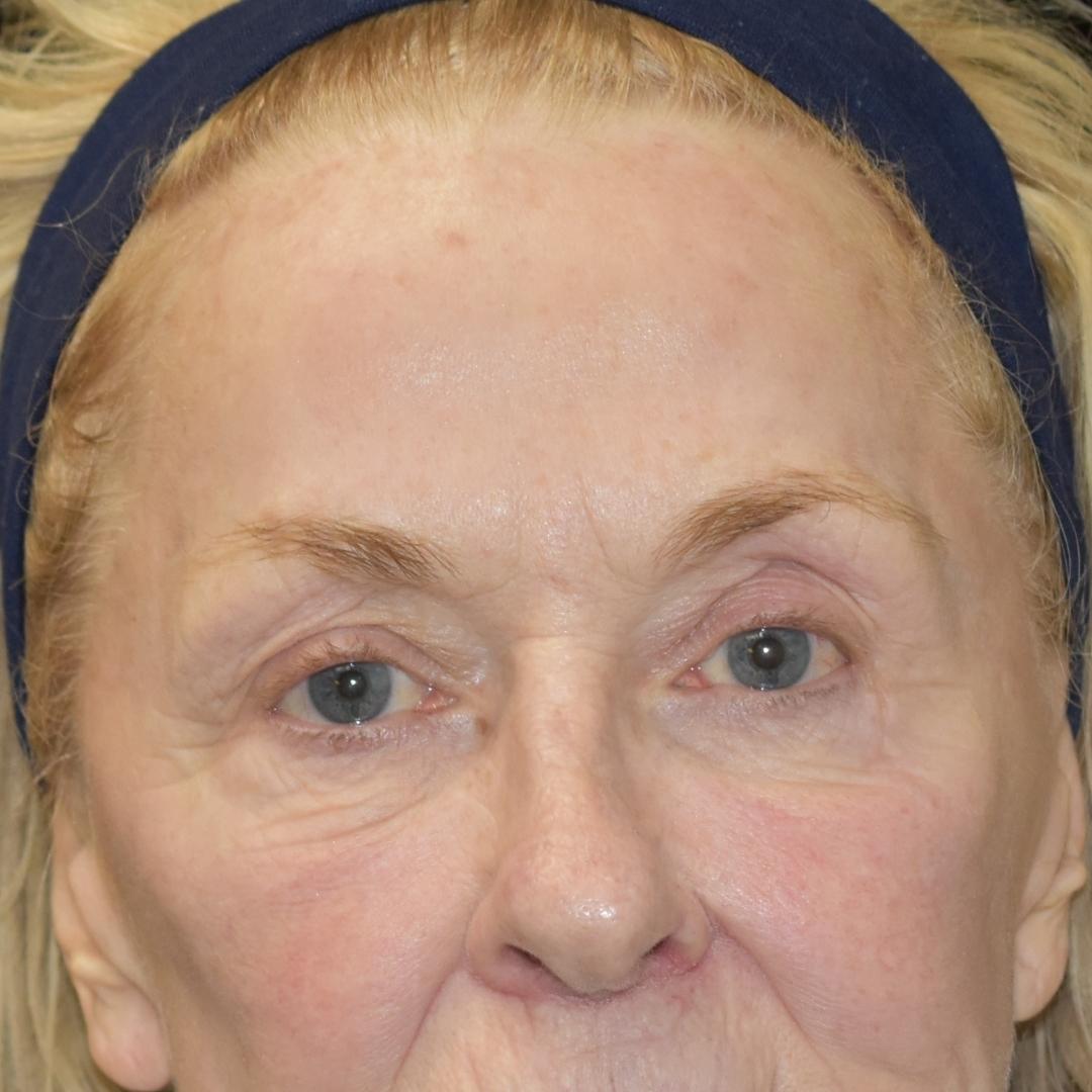 Botox & Dysport Patient Photo - Case 7774 - before view-1