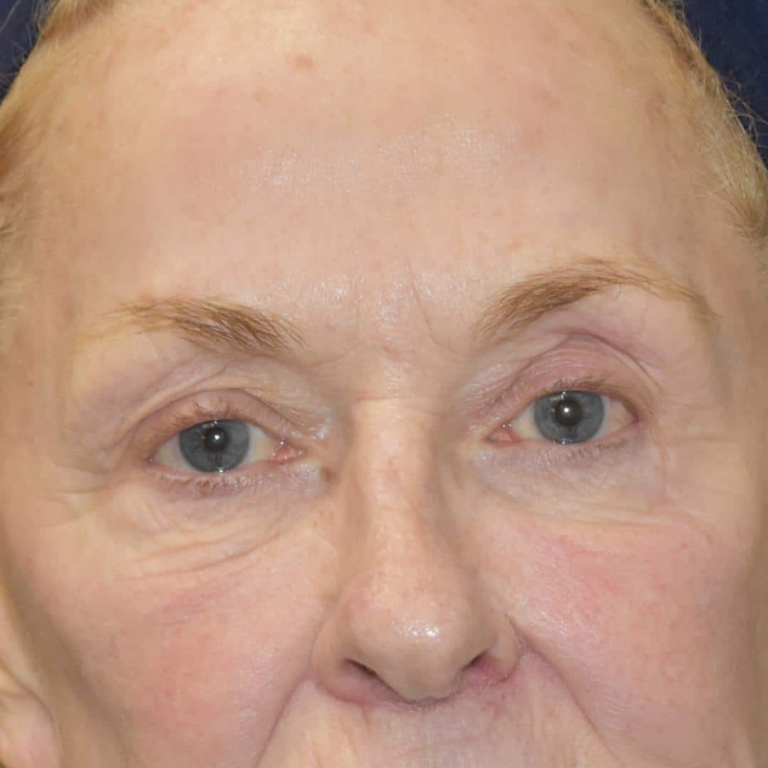 Botox & Dysport Patient Photo - Case 7774 - before view-0