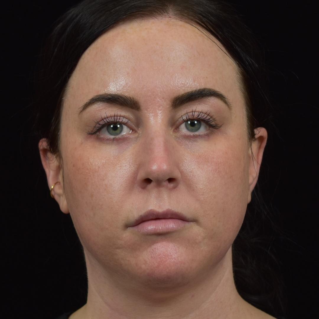 CO2 laser resurfacing Patient Photo - Case 7779 - before view-1