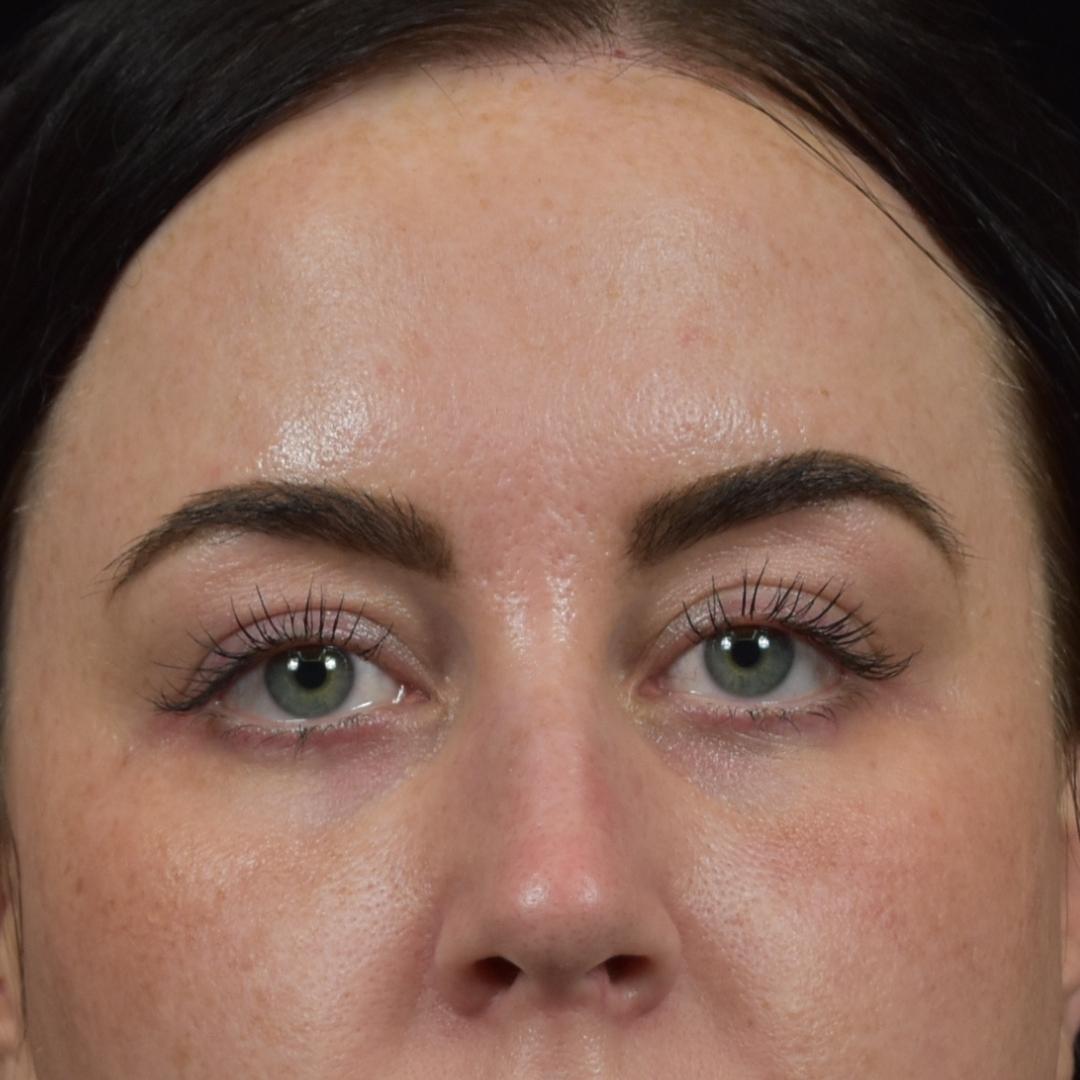 CO2 laser resurfacing Patient Photo - Case 7779 - before view-2