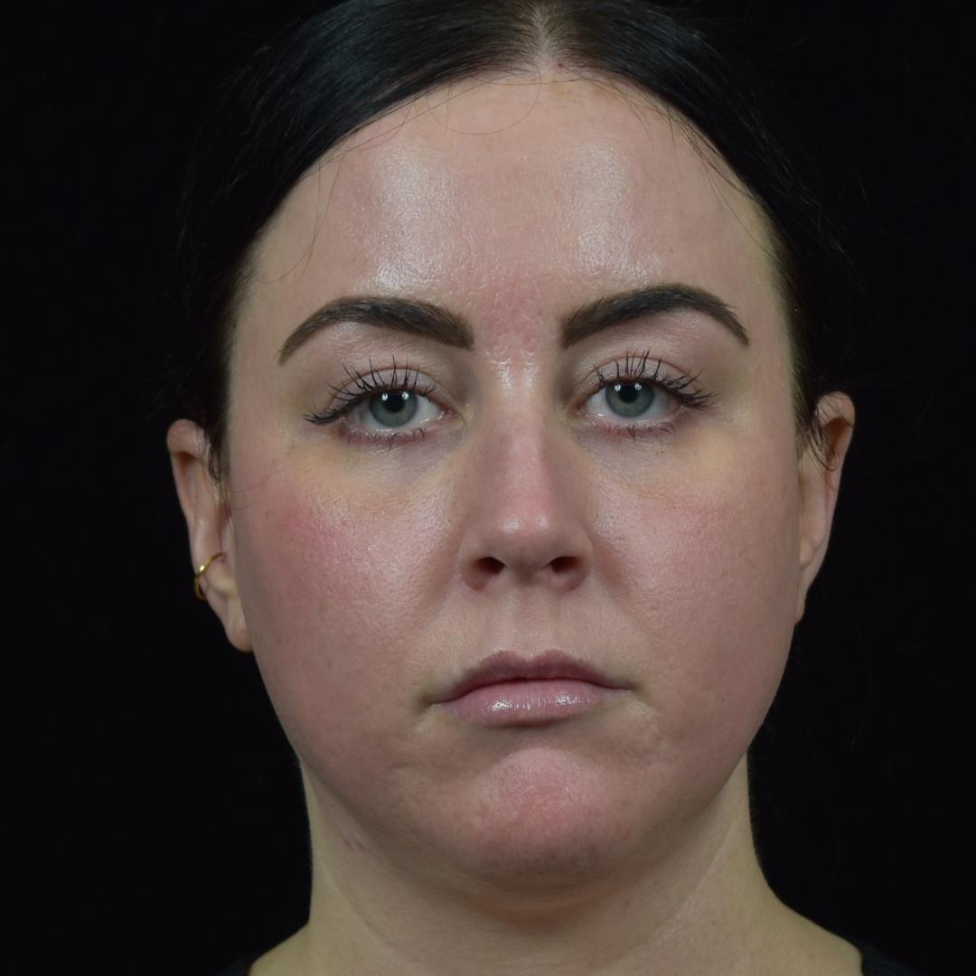 CO2 laser resurfacing Patient Photo - Case 7779 - after view-1