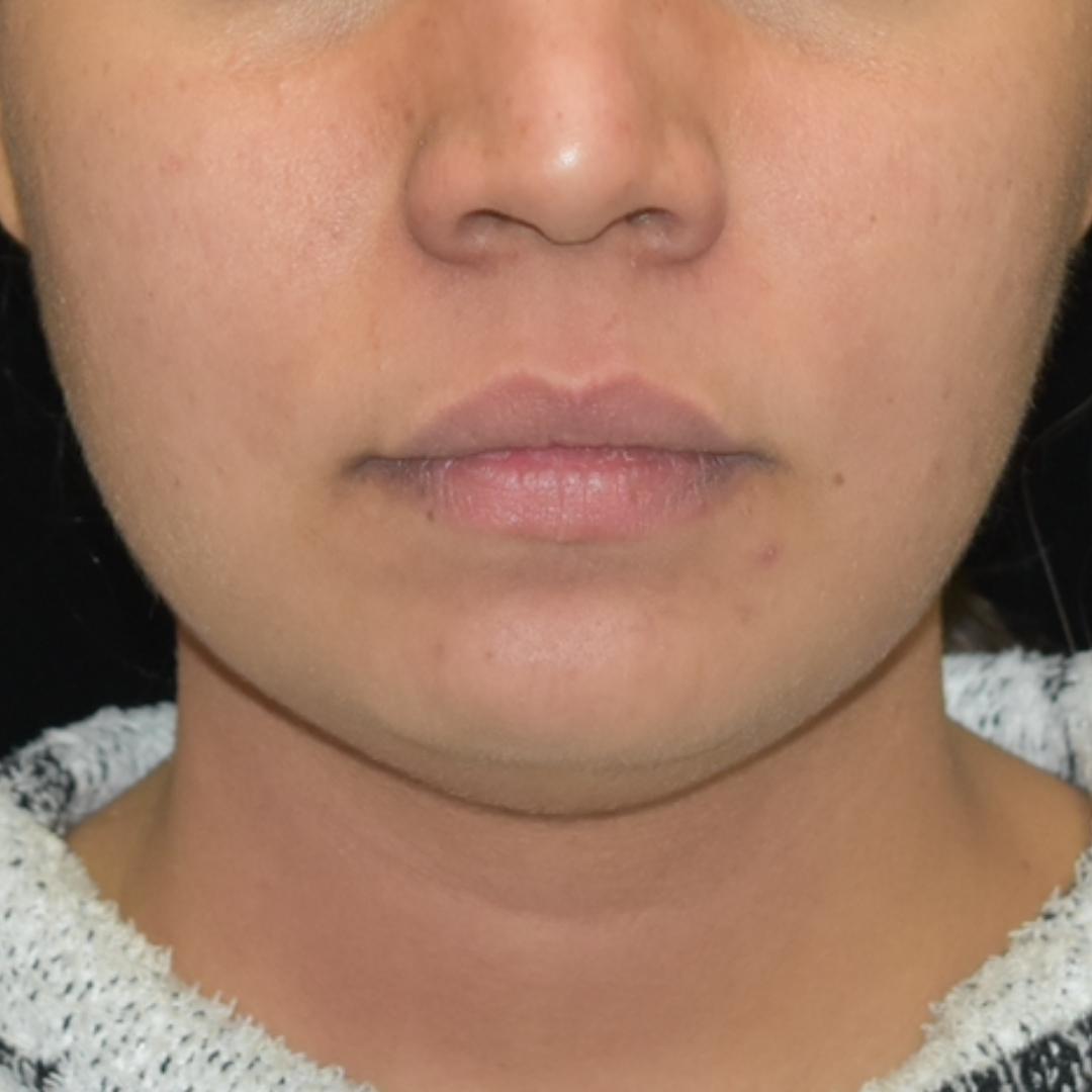 FaceTite/Accutite/Neck & Jawline Liposuction Patient Photo - Case 7798 - before view-