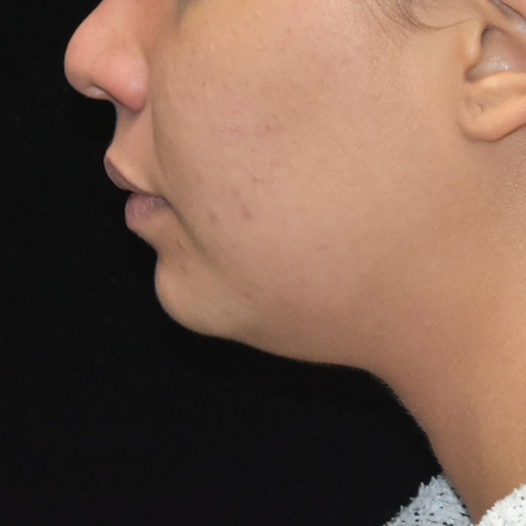 FaceTite/Accutite/Neck & Jawline Liposuction Patient Photo - Case 7798 - before view-1