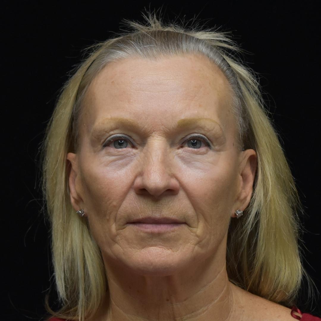 Dermal Fillers Patient Photo - Case 7816 - before view-1