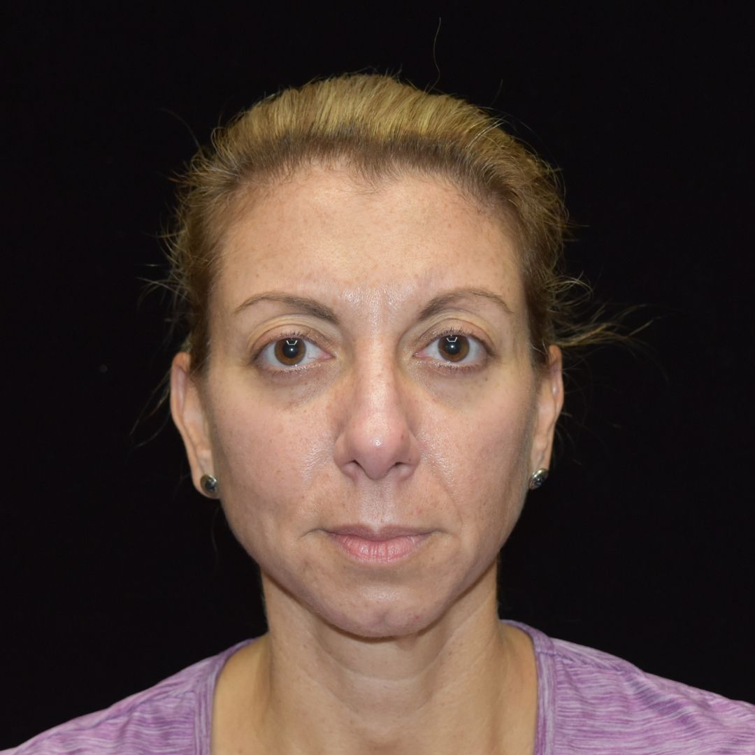 Dermal Fillers Patient Photo - Case 7822 - before view-0
