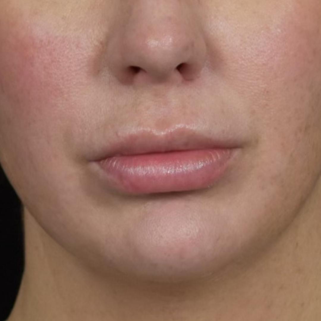 Dermal Fillers Patient Photo - Case 7827 - before view-