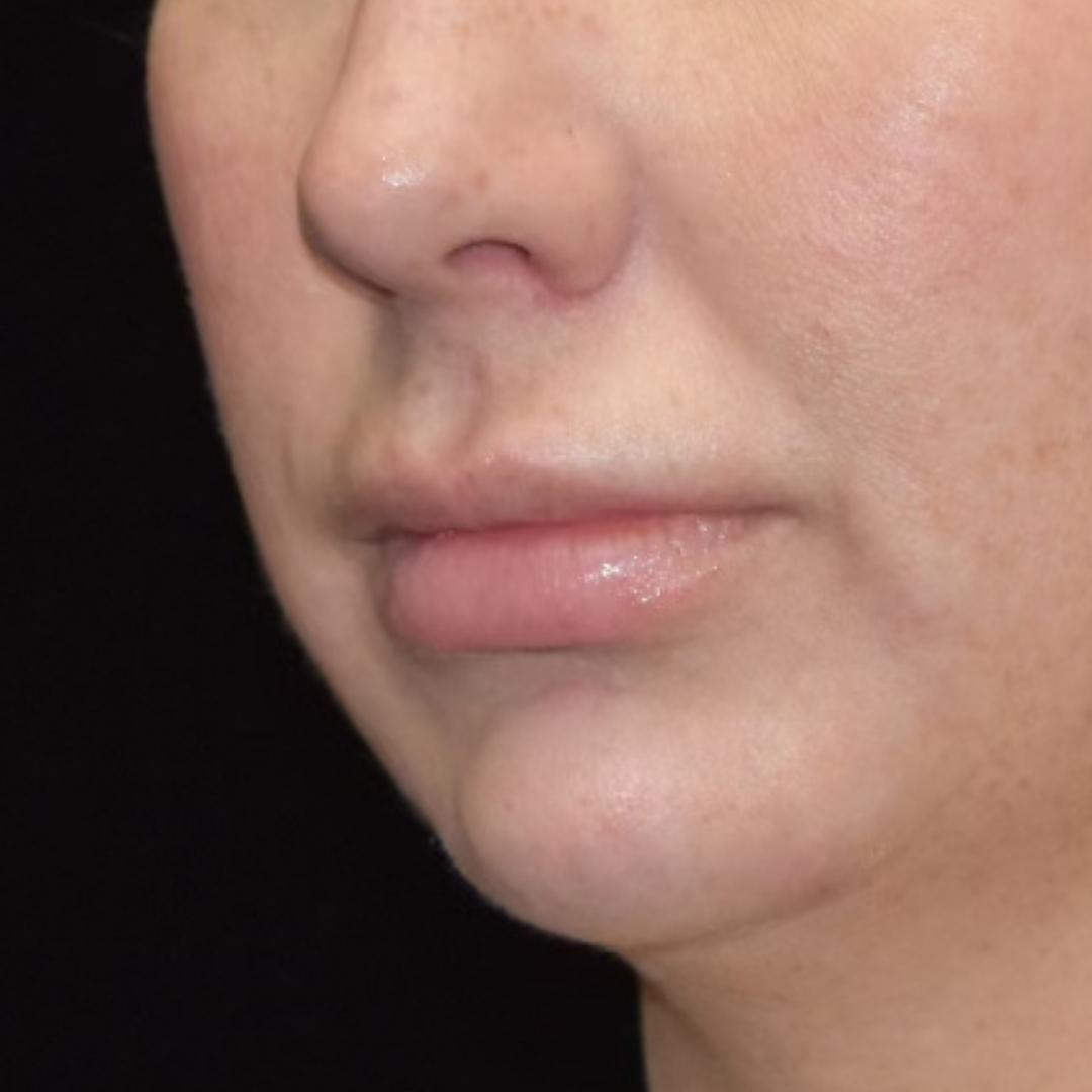 Dermal Fillers Patient Photo - Case 7827 - before view-1