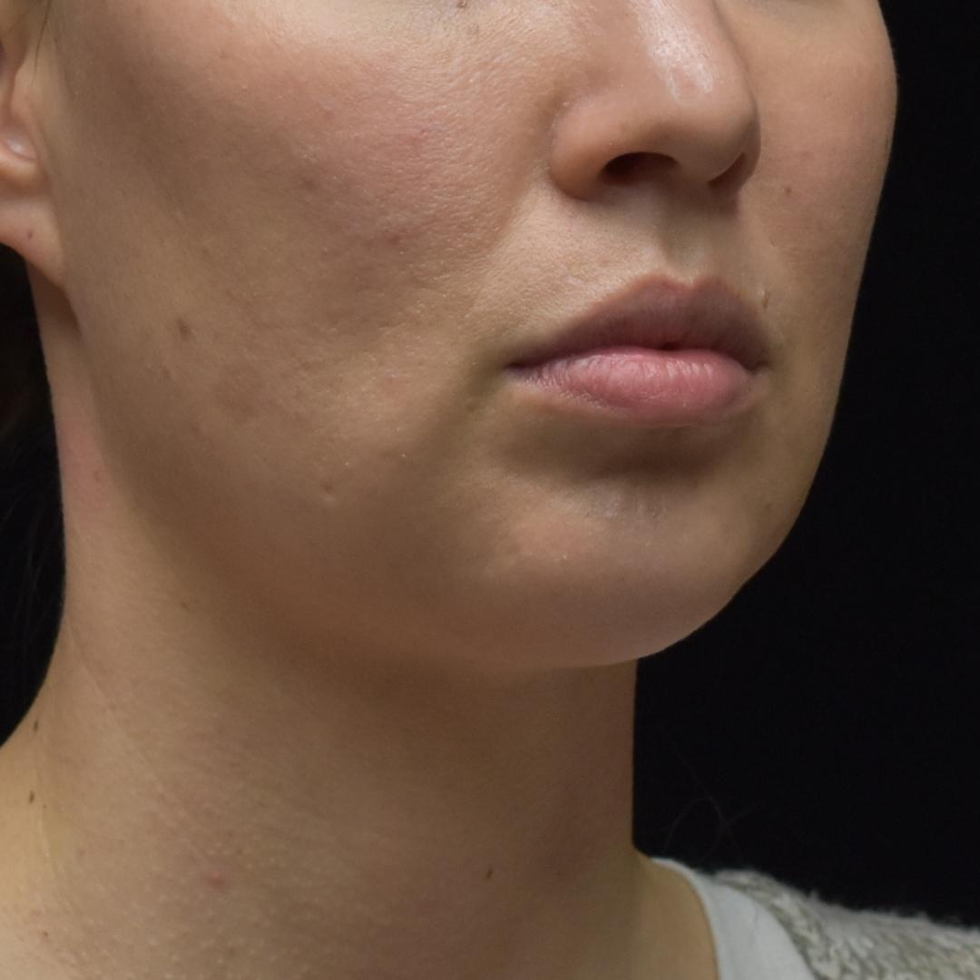 Dermal Fillers Patient Photo - Case 7832 - before view-0