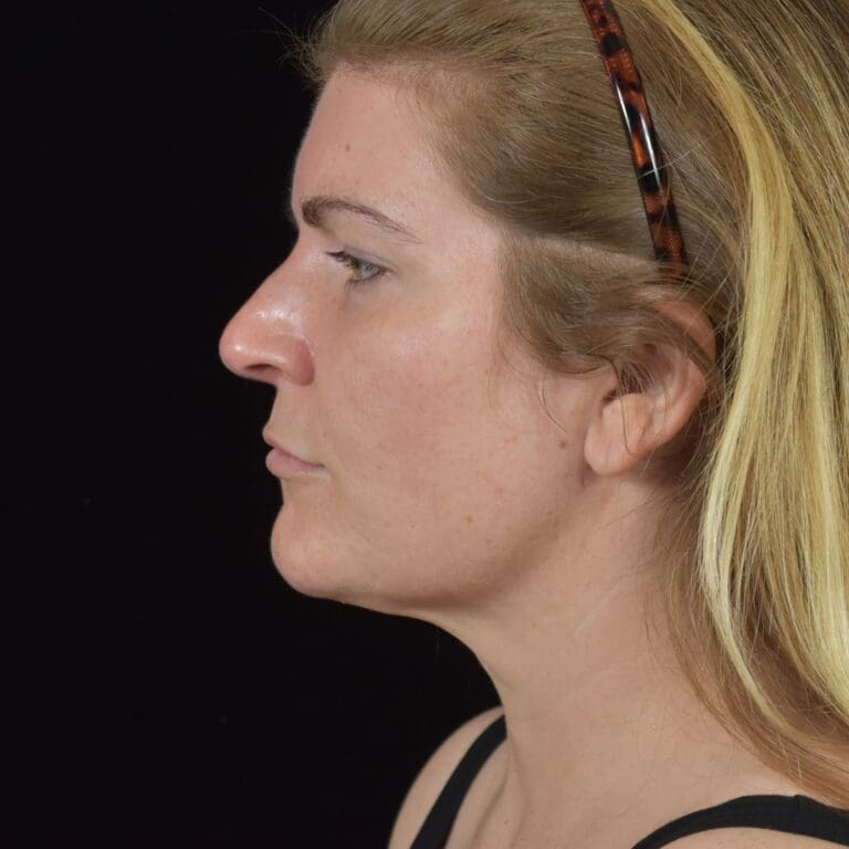 FaceTite/Accutite/Neck & Jawline Liposuction - Case 8393 - After