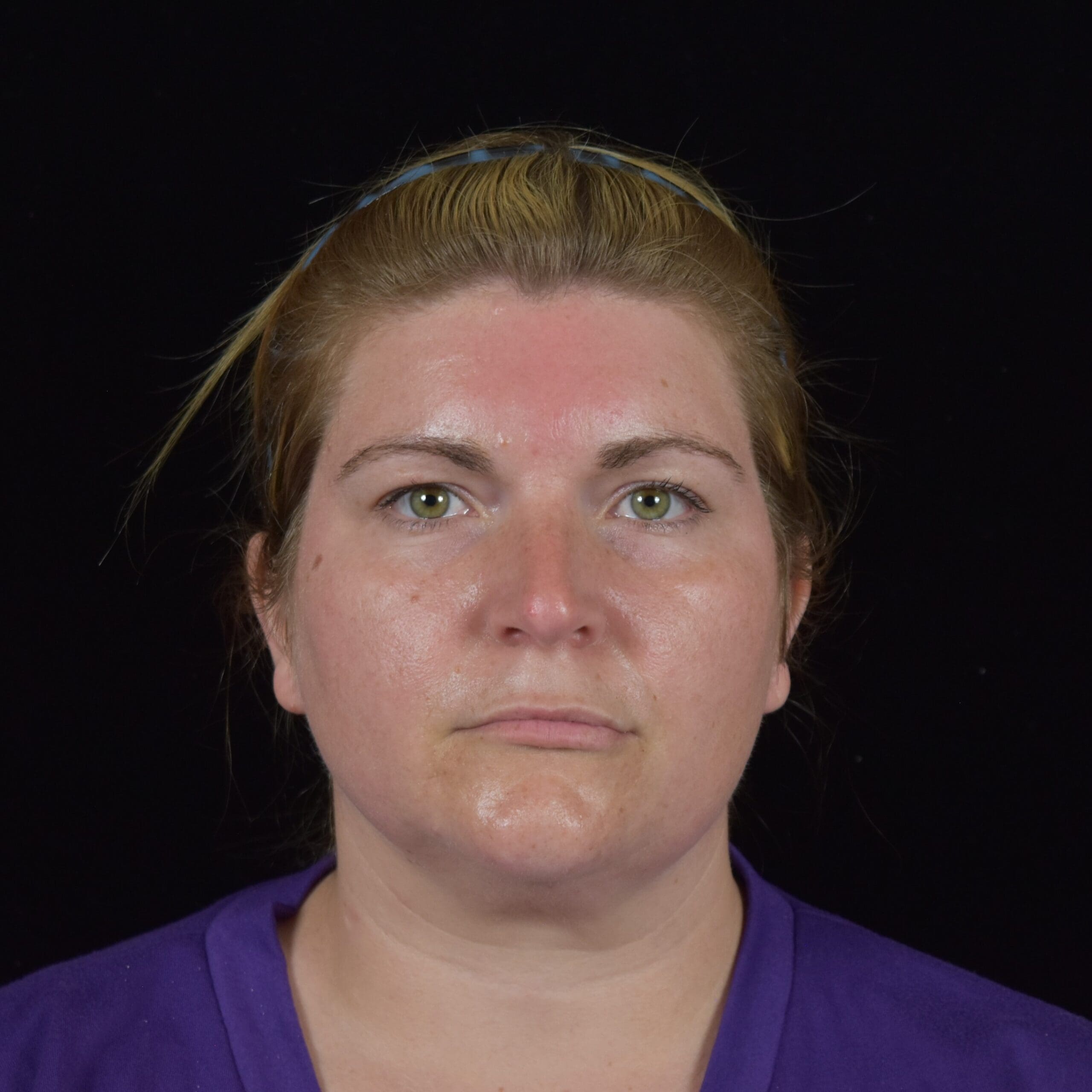 FaceTite/Accutite/Neck & Jawline Liposuction Patient Photo - Case 8393 - before view-1