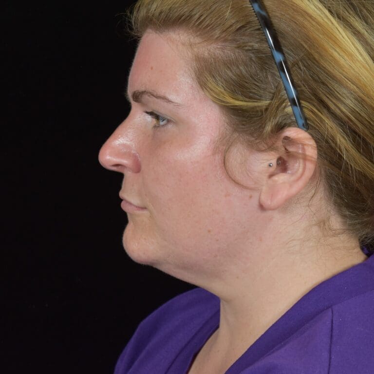 FaceTite/Accutite/Neck & Jawline Liposuction - Case 8393 - Before