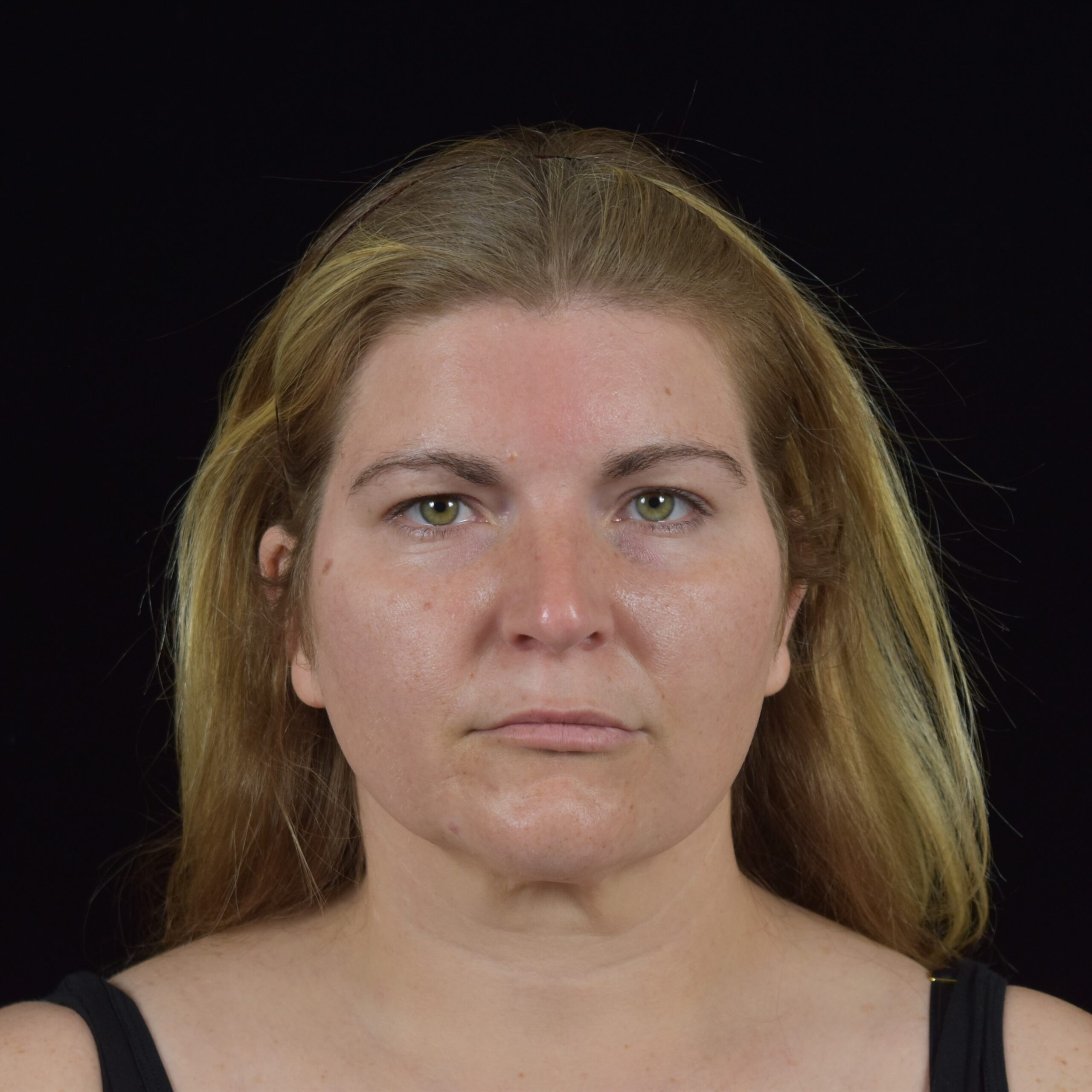 FaceTite/Accutite/Neck & Jawline Liposuction Patient Photo - Case 8393 - after view-1