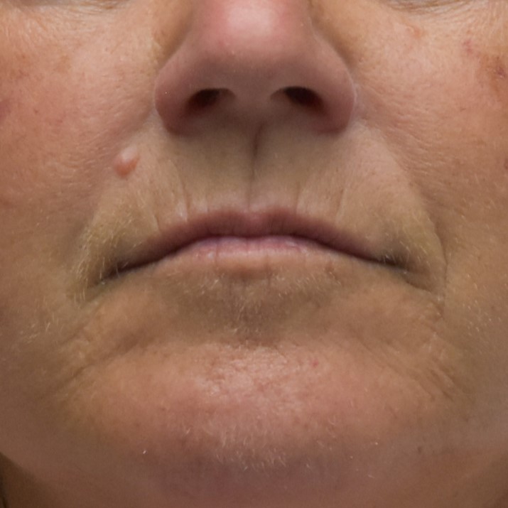 Dermal Fillers Patient Photo - Case 8398 - before view-