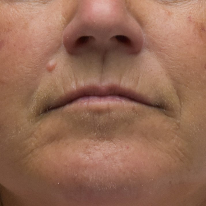 Dermal Fillers - Case 8398 - Before