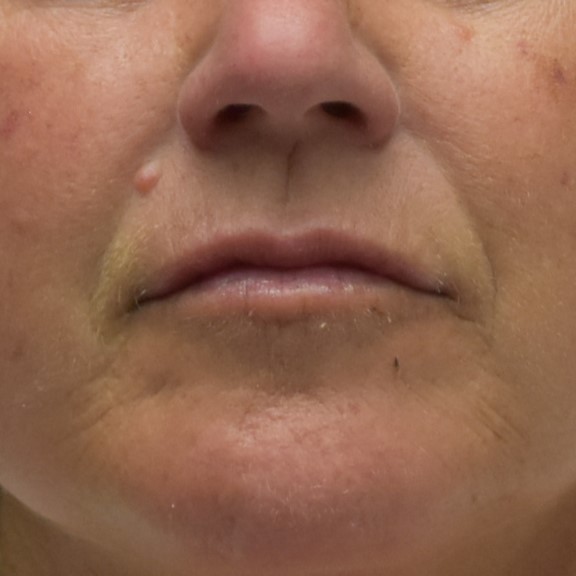 Dermal Fillers - Case 8398 - After