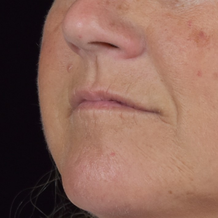Dermal Fillers Patient Photo - Case 8398 - before view-1