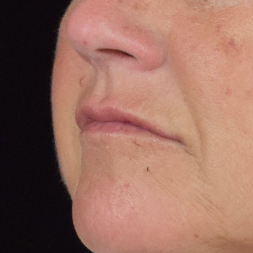 Dermal Fillers Patient Photo - Case 8398 - after view-1