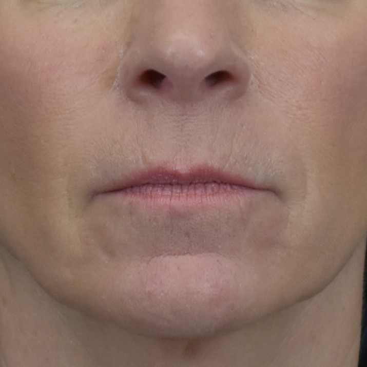 Dermal Fillers - Case 8403 - After