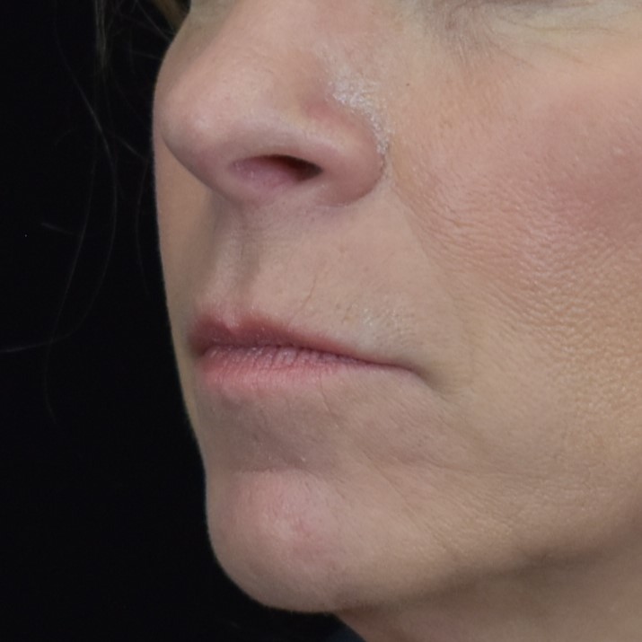 Dermal Fillers Patient Photo - Case 8403 - after view-1