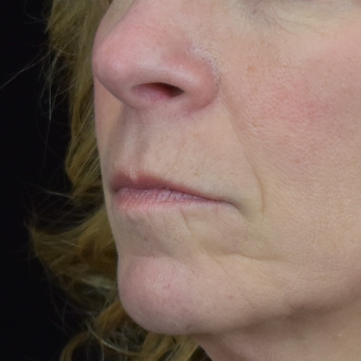 Dermal Fillers Patient Photo - Case 8403 - before view-1