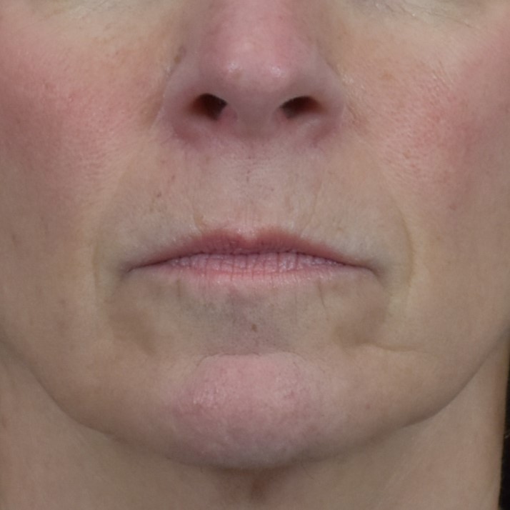 Dermal Fillers Patient Photo - Case 8403 - before view-