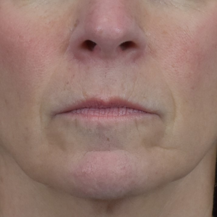 Dermal Fillers - Case 8403 - Before