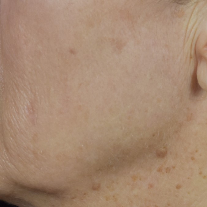 Lumecca IPL (Intense Pulsed Light) - Case 8408 - After