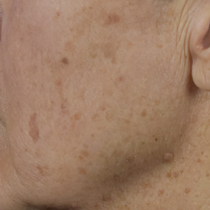 Lumecca IPL (Intense Pulsed Light) - Case 8408 - Before