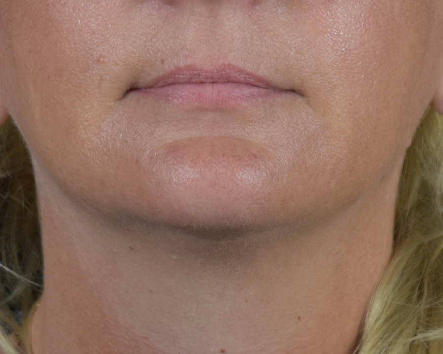 Dermal Fillers Patient Photo - Case 8411 - before view-