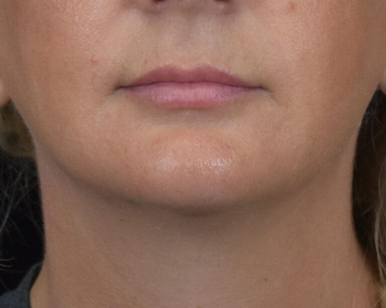 Dermal Fillers - Case 8411 - After