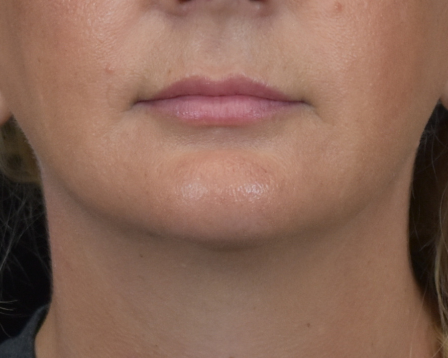 Dermal Fillers Patient Photo - Case 8411 - after view