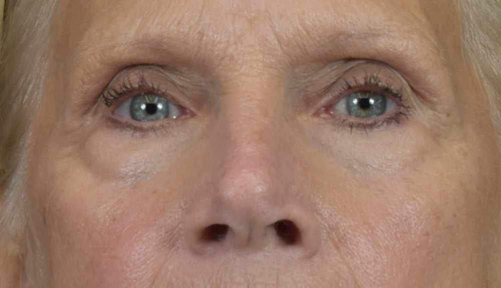 Dermal Fillers Patient Photo - Case 8414 - before view-1