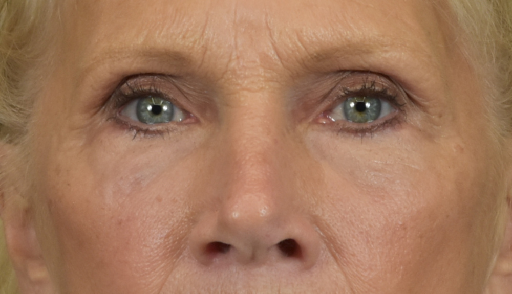 Dermal Fillers Patient Photo - Case 8414 - after view-1