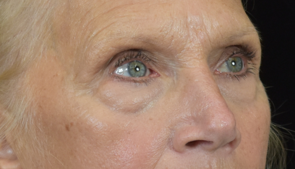 Dermal Fillers Patient Photo - Case 8414 - before view-