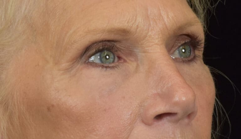 Dermal Fillers - Case 8414 - After