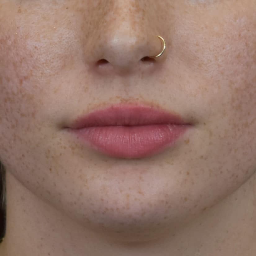 Dermal Fillers Patient Photo - Case 8594 - after view