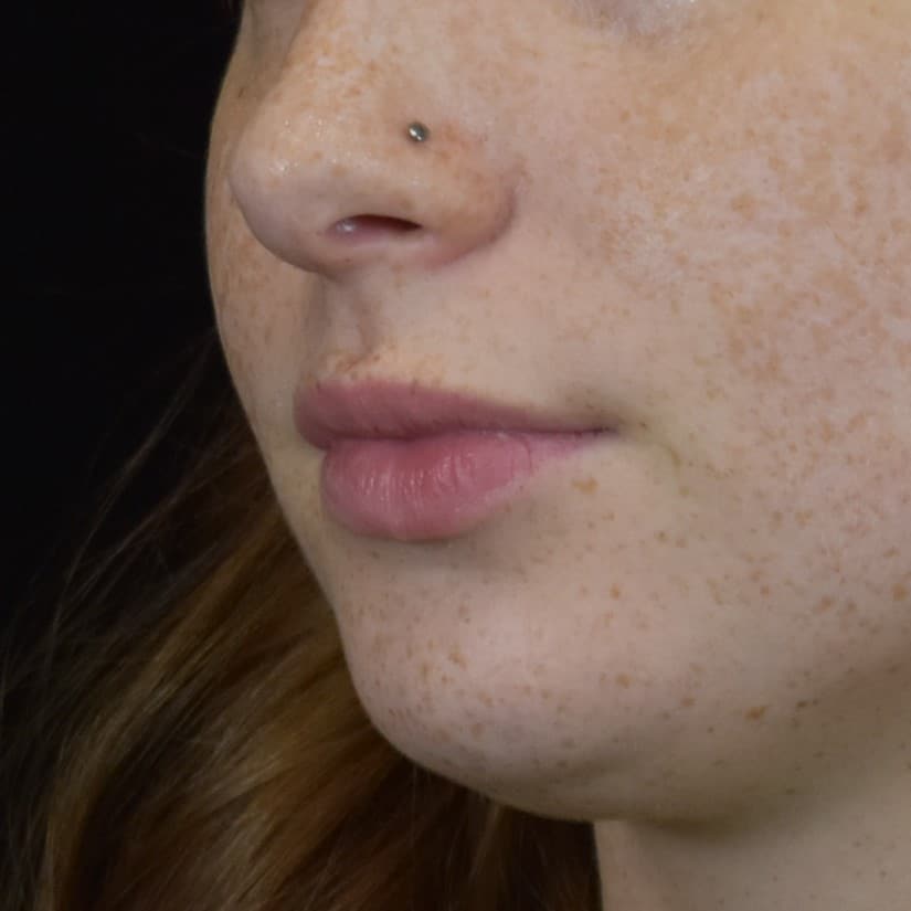 Dermal Fillers Patient Photo - Case 8594 - before view-1