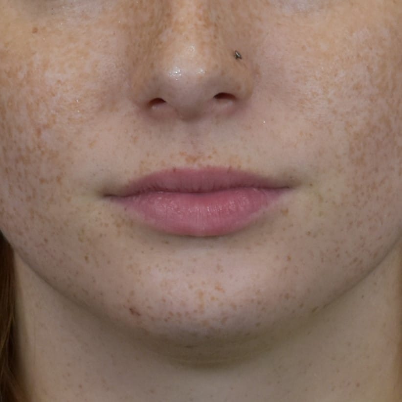 Dermal Fillers Patient Photo - Case 8594 - before view-