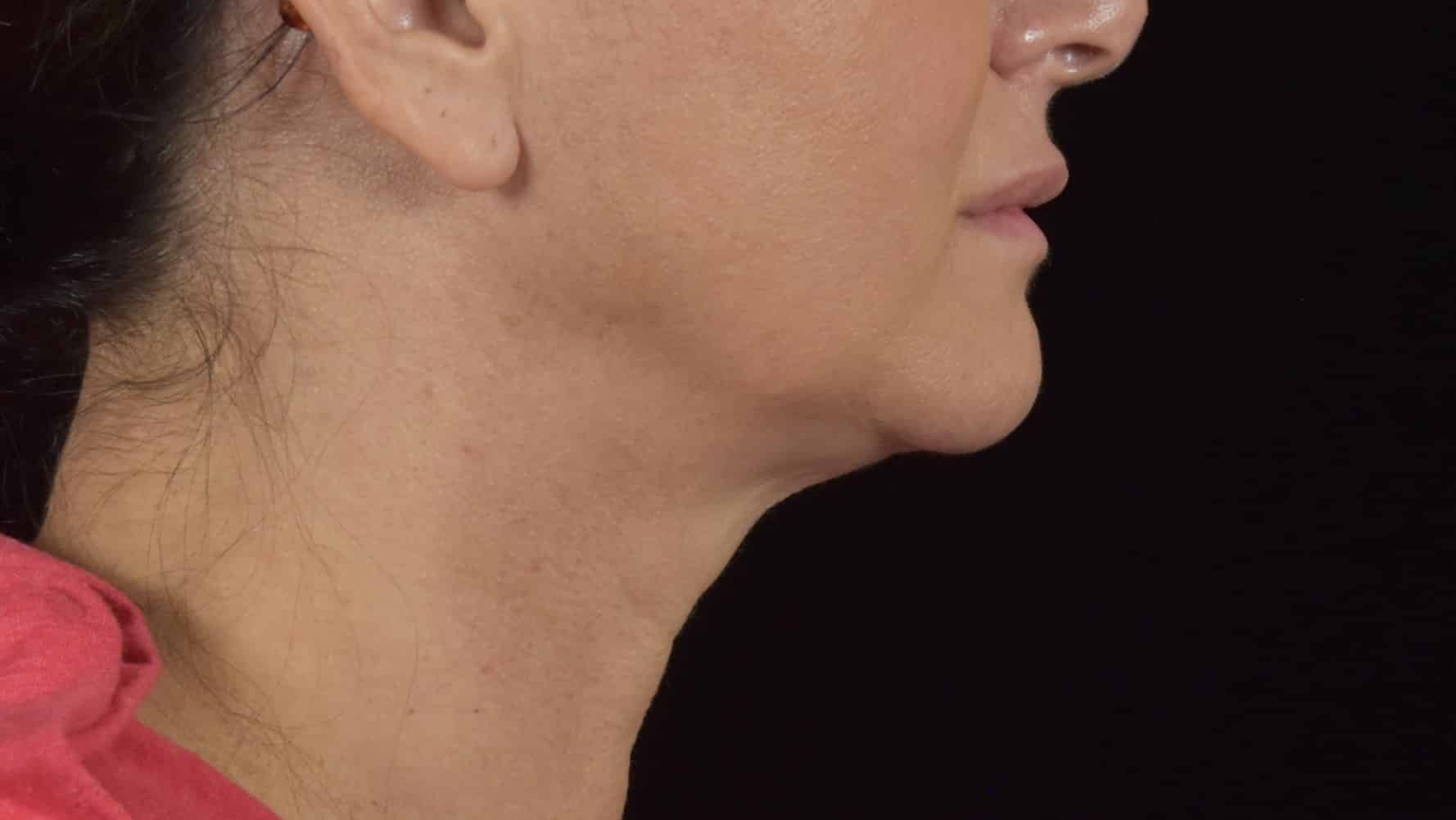 FaceTite/Accutite/Neck & Jawline Liposuction Patient Photo - Case 8600 - before view-